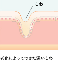 老化によってできた深いしわ