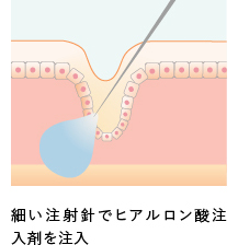 細い注射針でヒアルロン酸注入剤を注入