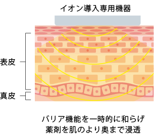 バリア機能を一時的に和らげ 薬剤を肌のより奥まで浸透