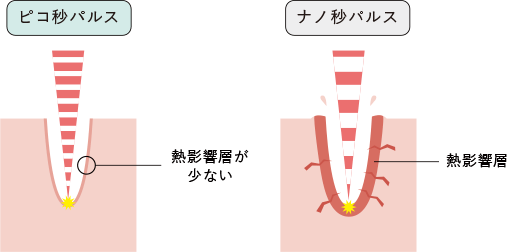 周りの組織を傷つけずシミだけを効能的に治療できる