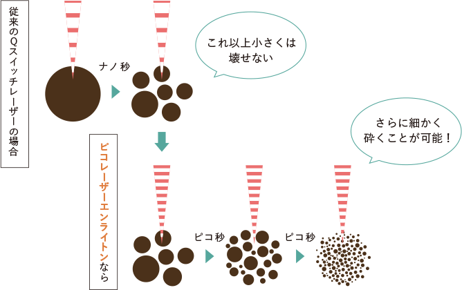 ピコレーザーによる衝撃波でメラニン色素を細かく破砕することで、排泄されやすくなる