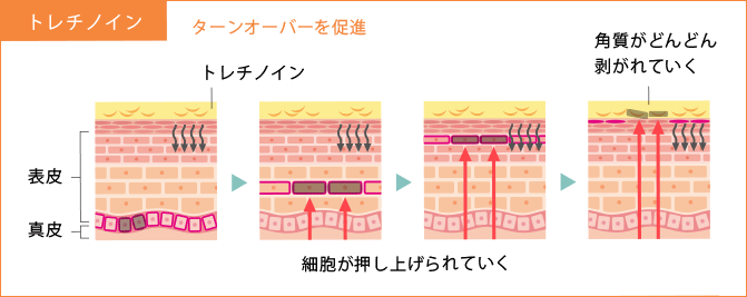 トレチノイン